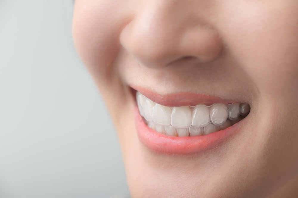 A detailed close-up of a person’s smile showcasing clear Invisalign aligners, highlighting their discreet and comfortable fit – Invisalign Alhambra.